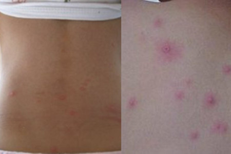 【图】了解水痘初期症状有哪些 做到早发现快治疗