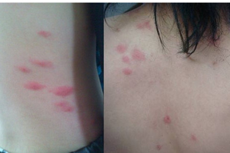 【图】螨虫性皮炎 引发了各种肌肤问题