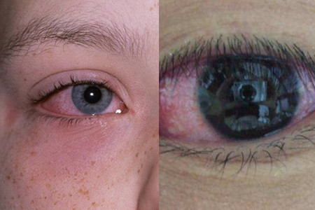 【图】眼睛发炎肿了怎么快速消肿 这五种方法可以帮助你