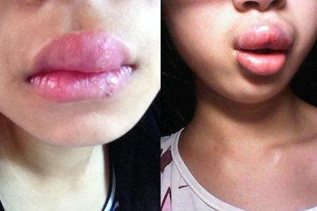 口唇疱疹是由于单纯性疱疹病毒