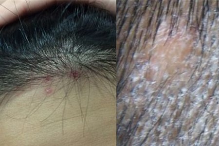 头皮癣靠什么传染 如何判断皮肤健康