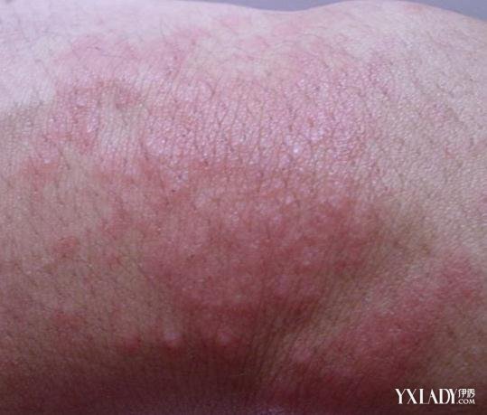 季节性皮肤过敏的表现有哪些 转季皮肤过敏瘙痒怎么办