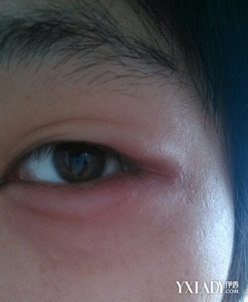 眼睛肿是什么原因