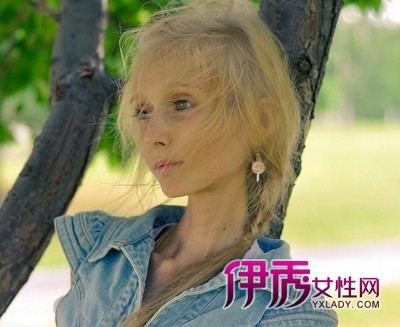 <em>俄罗斯少女减肥</em>过度成恐怖骷髅人