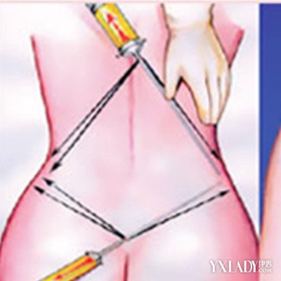【图】抽脂丰胸整形手术 助你达到瘦身塑形的