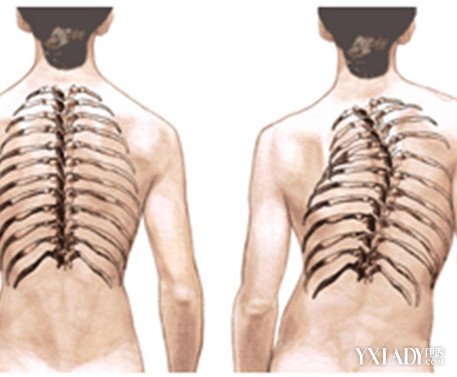 【图】患了脊柱侧弯自我矫正法有哪些? 4大方法教你矫正脊柱