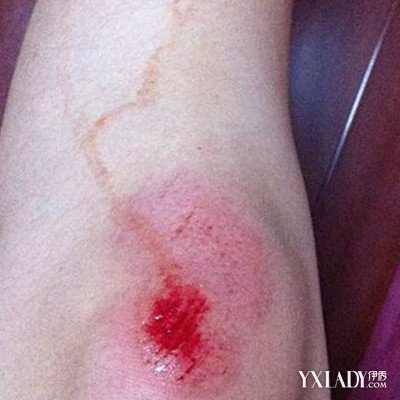擦伤是皮肤表面被粗糙物擦破的损伤,最常见的是手掌,肘部,膝盖,小腿