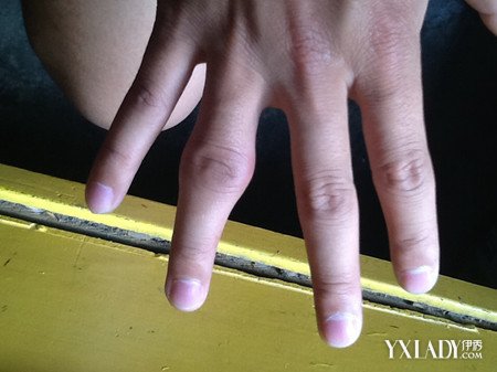 手指是骨质增生常见的发生部位,位置多见于末节指间背侧(指甲下方)的