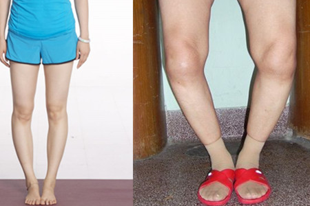 【图】o型腿可以治疗吗,,,了解这些常识轻松告别腿部问题