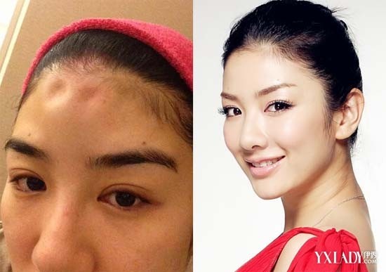 [图] 黄奕离婚 晒额头被打凹惨状 老公曝家中监控