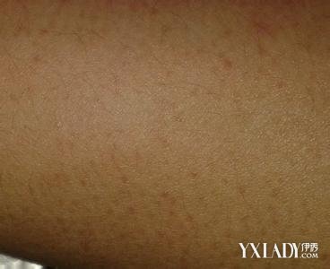 Ƥ������֢