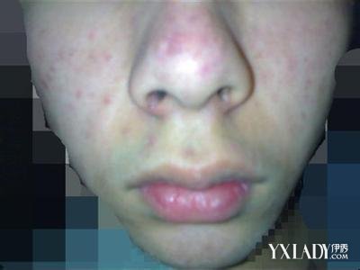 Ƥ������֢