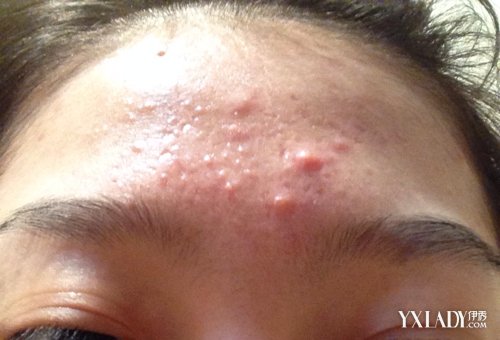 【图】严重的痤疮印图片 4款清除座疮的方法任你挑选