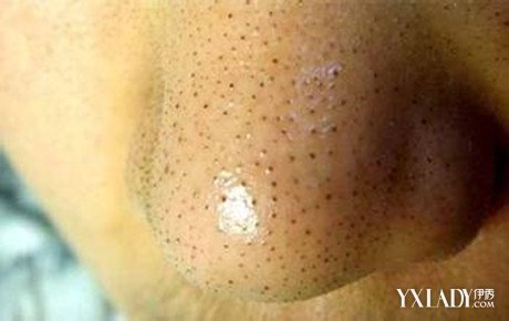 鼻子上黑头变多的原因有哪些