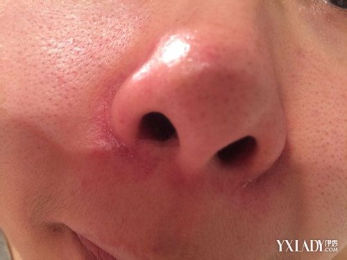 【图】造成鼻子红红的是什么原因 了解形成红鼻子的重要影响因素