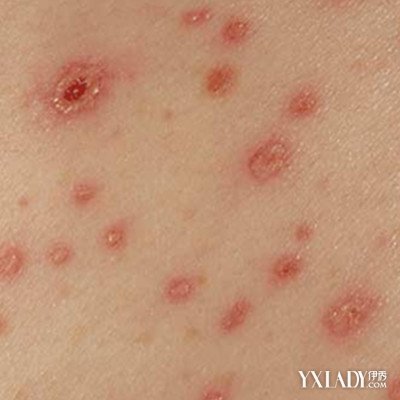 【图】脸上总长痘痘怎么办呢 注意个人卫生不