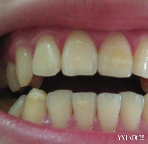 【图】怎样才能让牙齿变白而不是发黄 9个小妙