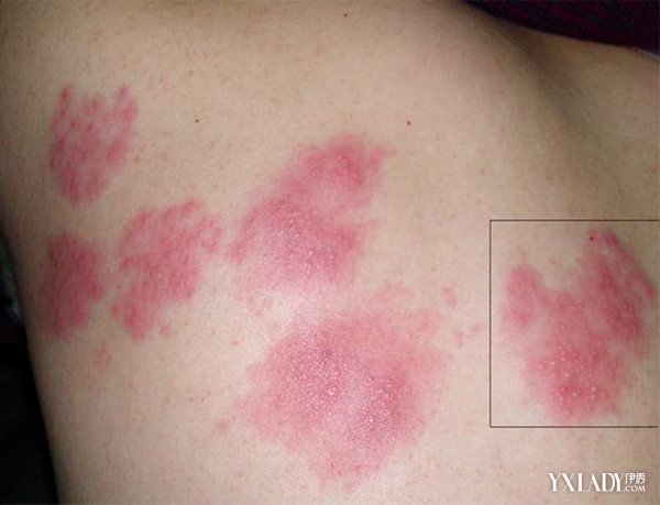 皮肤斑疹严重吗 如何处理该症状的发生