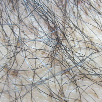 【图】阴虱在头发上怎么办呢? 盘点你需了解的