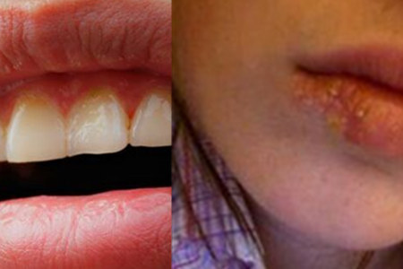 嘴唇长泡抹牙膏 有助于水泡的消除