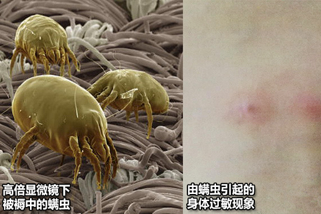 人体螨虫感染图片图片